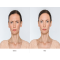 Injections de toxine botulique 100iu visage botox minceur